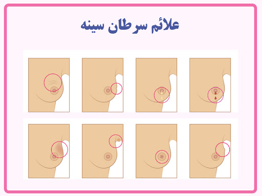 علائم سرطان سینه
