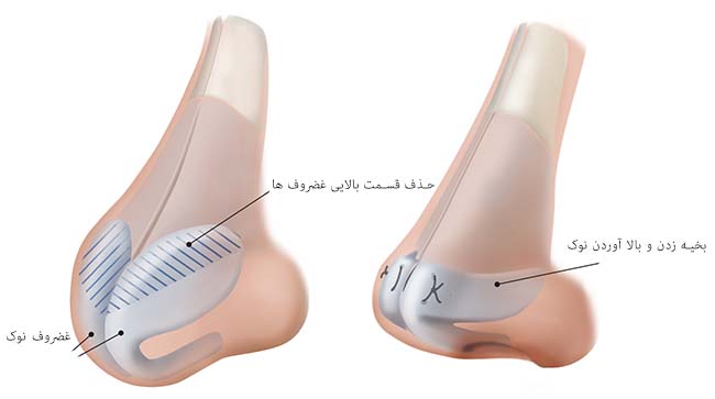 افتادگی نوک بینی در جراحی بینی